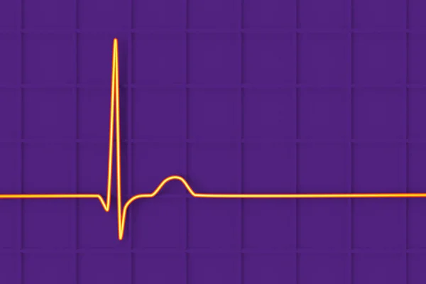 Elektrocardiogram Ecg Toont Een Junctioneel Ritme Die Optreedt Wanneer Elektrische — Stockfoto
