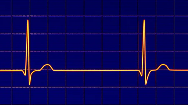 Elektrocardiogram Ecg Toont Een Junctioneel Ritme Die Optreedt Wanneer Elektrische — Stockfoto