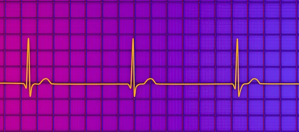 Elektrokardiogramm Ekg Das Einen Übergangsrhythmus Anzeigt Der Eintritt Wenn Die — Stockfoto