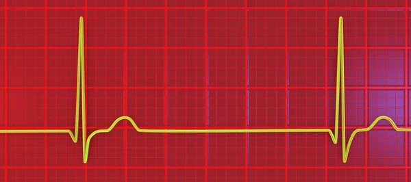 Electrocardiogram Ecg Displaying Junctional Rhythm Which Occurs Electrical Signals Heart — Stock Photo, Image