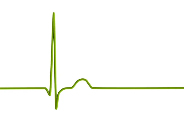 Электрокардиограмма Экг Отображающая Узловой Ритм Который Возникает Электрические Сигналы Сердце — стоковое фото