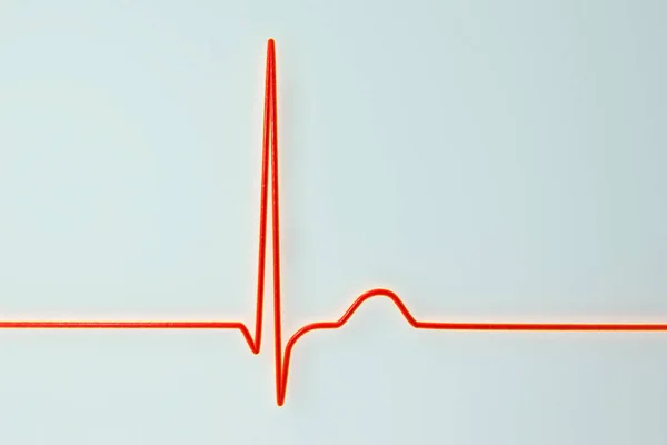 Electrocardiograma Ecg Que Muestra Ritmo Unión Que Ocurre Cuando Las — Foto de Stock