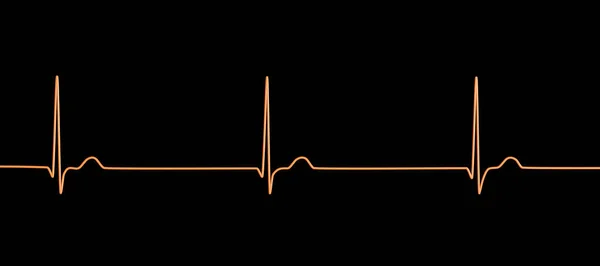 Electrocardiograma Ecg Que Muestra Ritmo Unión Que Ocurre Cuando Las — Foto de Stock