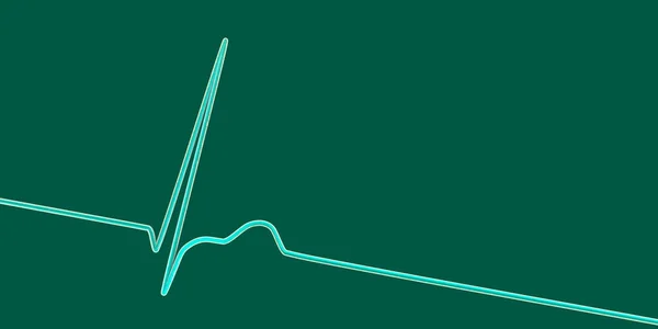 Eletrocardiograma Ecg Exibindo Ritmo Juncional Que Ocorre Quando Sinais Elétricos — Fotografia de Stock