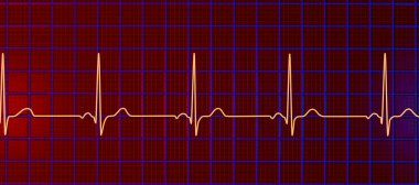 Normal bir elektrokardiyogram EKG, sağlıklı bir bireyde kalbin elektriksel aktivitesini gösteren 3 boyutlu bir çizim.