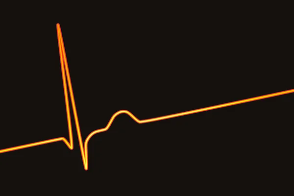 Elektrokardiogram Ekg Wyświetlający Rytm Łącznikowy Który Występuje Gdy Sygnały Elektryczne — Zdjęcie stockowe