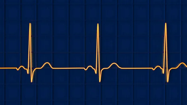 Normál Elektrokardiogram Ekg Illusztráció Amely Egészséges Egyénben Mutatja Szív Elektromos — Stock Fotó