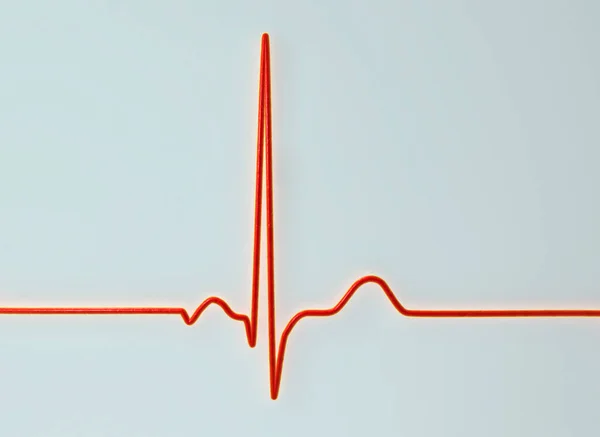 Normal Bir Elektrokardiyogram Ekg Sağlıklı Bir Bireyde Kalbin Elektriksel Aktivitesini — Stok fotoğraf