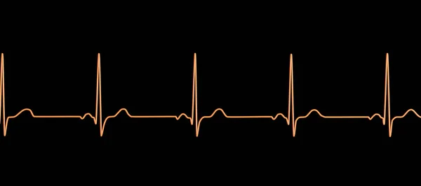 Normalny Elektrokardiogram Ekg Ilustracja Pokazująca Aktywność Elektryczną Serca Zdrowej Osoby — Zdjęcie stockowe