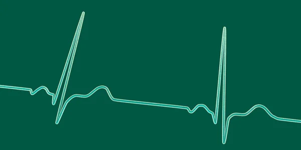 Normální Elektrokardiogram Ekg Ilustrace Zobrazující Elektrickou Aktivitu Srdce Zdravého Jedince — Stock fotografie