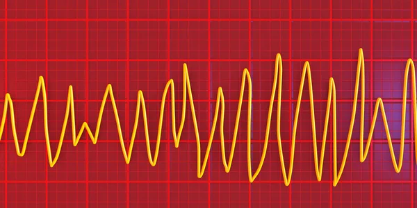 Ecg Visualizzazione Torsioni Punta Ritmo Ritmo Cardiaco Pericoloso Con Veloce — Foto Stock