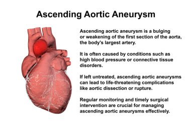 Yükselen aort anevrizması olan bir insan kalbi, genişlemeyi ve bu durumla ilişkili potansiyel sağlık risklerini vurgulayan 3 boyutlu illüstrasyon