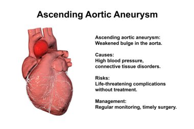 Yükselen aort anevrizması olan bir insan kalbi, genişlemeyi ve bu durumla ilişkili potansiyel sağlık risklerini vurgulayan 3 boyutlu illüstrasyon