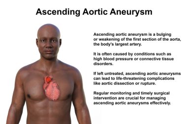 Şeffaf derili bir Afrikalı adamın üst kısmının 3 boyutlu fotorealistik bir çizimi, yükselen bir aort anevrizmasını ortaya çıkarıyor.