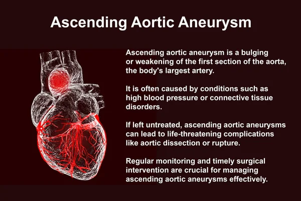 Human Heart Ascending Aortic Aneurysm Illustration Emphasizing Dilation Potential Health — Stock Photo, Image