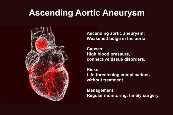 Lidské Srdce Vzestupnou Aortální Aneurysma Ilustrace Zdůrazňující Dilataci Potenciální Zdravotní — Stock fotografie