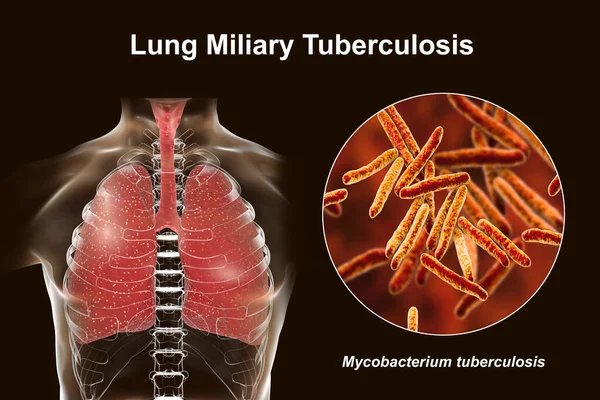 Stock image A detailed 3D photorealistic illustration showcasing human lungs affected by miliary tuberculosis, with a close-up view of the Mycobacterium tuberculosis bacteria responsible for the infection