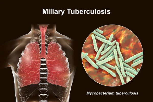 Uma Ilustração Fotorealista Detalhada Mostrando Pulmões Humanos Afetados Pela Tuberculose — Fotografia de Stock