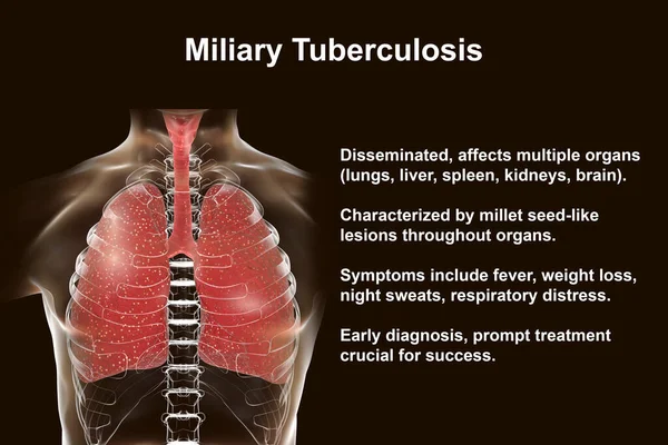 Une Illustration Photoréaliste Détaillée Montrant Les Poumons Humains Atteints Tuberculose — Photo