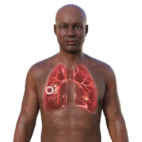 Şeffaf Derili Bir Adamın Mağara Tüberkülozundan Etkilenen Akciğerlerini Gösteren Boyutlu — Stok fotoğraf