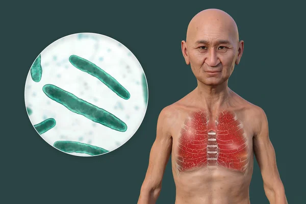 A 3D photorealistic illustration of the upper half of a man with transparent skin, showcasing the lungs affected by miliary tuberculosis and close-up view of Mycobacterium tuberculosis bacteria