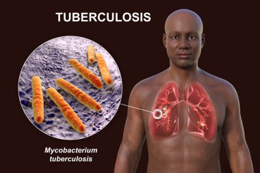 Şeffaf derili bir adamın üst yarısının 3 boyutlu fotorealistik çizimi, kavernöz tüberkülozdan etkilenen akciğerleri gösteriyor ve Mycobacterium tüberküloz bakterisinin yakın plan görüntüsü.