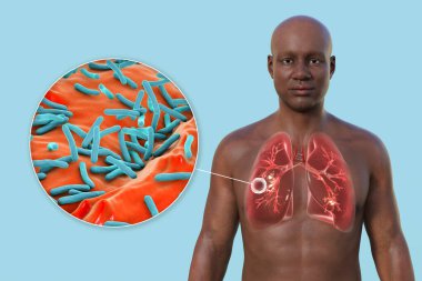 Şeffaf derili bir adamın üst yarısının 3 boyutlu fotorealistik çizimi, kavernöz tüberkülozdan etkilenen akciğerleri gösteriyor ve Mycobacterium tüberküloz bakterisinin yakın plan görüntüsü.