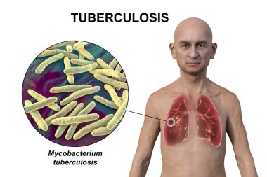 Şeffaf derili bir adamın üst yarısının 3 boyutlu fotorealistik çizimi, kavernöz tüberkülozdan etkilenen akciğerleri gösteriyor ve Mycobacterium tüberküloz bakterisinin yakın plan görüntüsü.