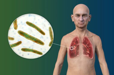 Şeffaf derili bir adamın üst yarısının 3 boyutlu fotorealistik çizimi, kavernöz tüberkülozdan etkilenen akciğerleri gösteriyor ve Mycobacterium tüberküloz bakterisinin yakın plan görüntüsü.