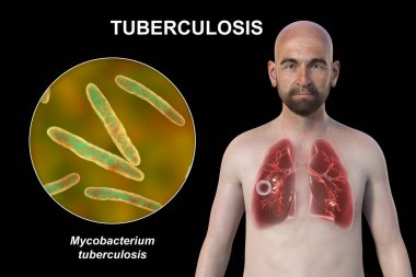 Şeffaf derili bir adamın üst yarısının 3 boyutlu fotorealistik çizimi, kavernöz tüberkülozdan etkilenen akciğerleri gösteriyor ve Mycobacterium tüberküloz bakterisinin yakın plan görüntüsü.