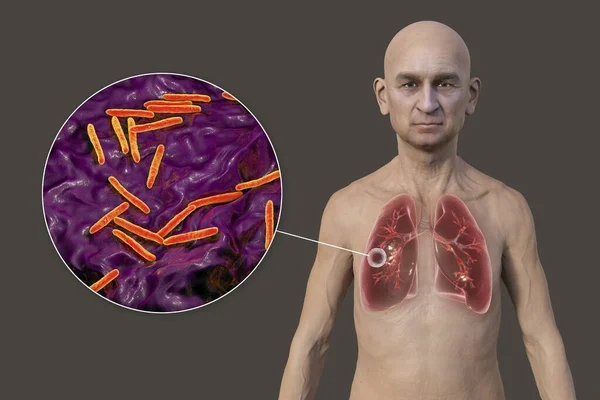 A 3D photorealistic illustration of the upper half of a man with transparent skin, showcasing the lungs affected by cavernous tuberculosis and close-up view of Mycobacterium tuberculosis bacteria