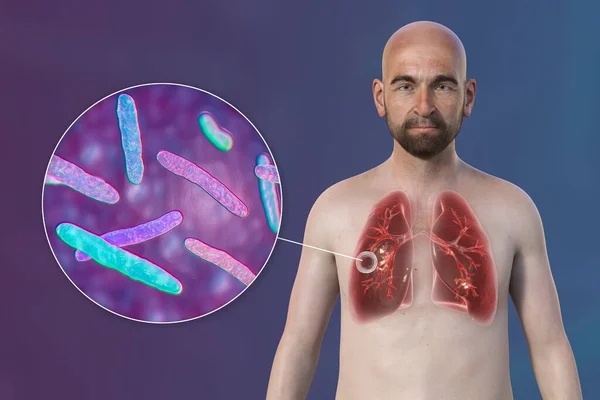一个具有透明皮肤的男子上半身的3D照片 展示了肺部感染腔结核的情况和结核分枝杆菌的特写 — 图库照片