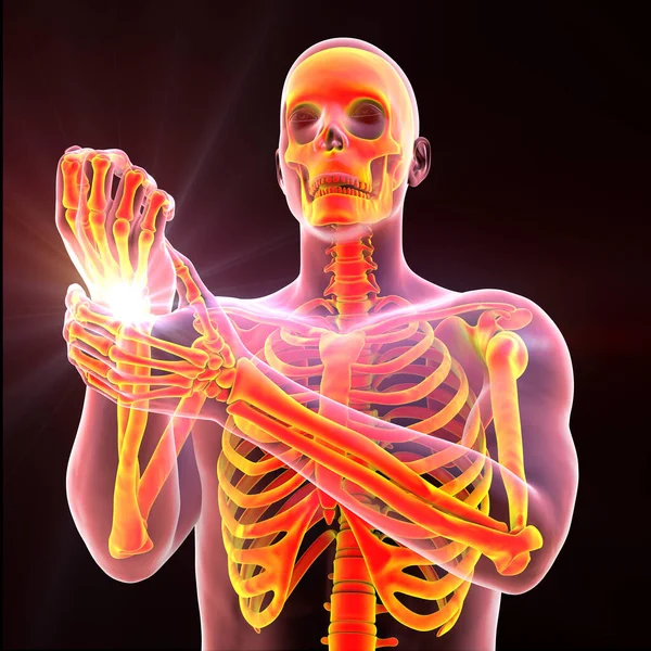 一个男人正在经历腕部疼痛 他的骨骼突出显示了受影响的区域 3D图解 — 图库照片