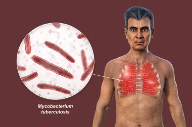 Şeffaf derili bir adamın üst yarısının 3 boyutlu fotorealistik çizimi, militer tüberkülozdan etkilenen akciğerleri ve Mycobacterium tüberküloz bakterisinin yakın plan görüntüsünü gösteriyor.