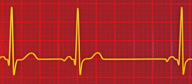 Sinüs aritmisini gösteren elektrokardiyogramın ayrıntılı bir 3D çizimi sinüs düğümünden kaynaklanan düzensiz kalp ritmiyle karakterize edilen bir durumdur..