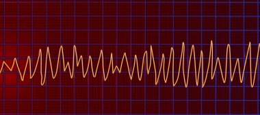 ECG göstergesi Torsades de point ritmi, tehlikeli kalp ritmi hızlı, düzensiz ritimler elektrik ekseni etrafında dönerek, potansiyel olarak bayılma veya kalp durmasına neden olur, 3D illüstrasyon