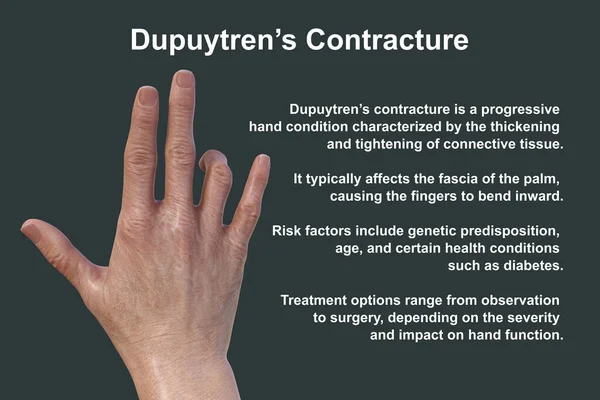 Hand Patient Dupuytren Contracture Condition Causes Fingers Bend Palm Photorealistic — Stock Photo, Image