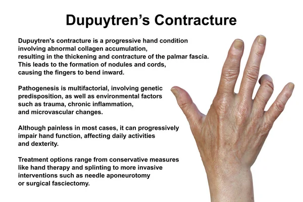 Ruka Pacienta Dupuytrenovou Kontrakturou Stav Který Způsobuje Prsty Ohnou Dlani — Stock fotografie