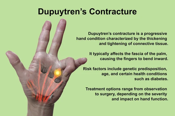 Medical Illustration Displaying Patient Hand Dupuytren Contracture Emphasizing Affected Tendons — Stock Photo, Image