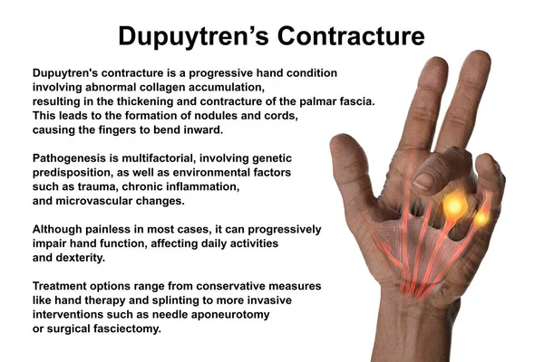Medical Illustration Displaying Patient Hand Dupuytren Contracture Emphasizing Affected Tendons — Stock Photo, Image