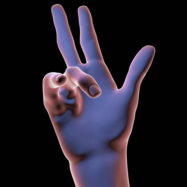 Dupuytren Sendromlu Bir Hastanın Eli Parmakları Avuç Içine Doğru Büken — Stok fotoğraf