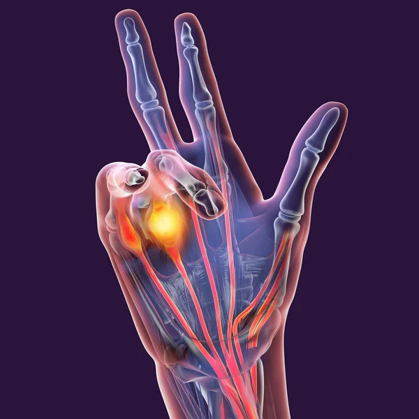 デュピュイトレンの収縮で患者の手を示す3D医療イラスト 状態の総病理を説明するために影響を受けた腱やParmar Fasciaを強調します — ストック写真