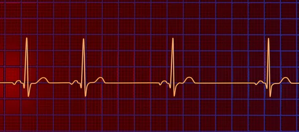 Sinüs Aritmisini Gösteren Elektrokardiyogramın Ayrıntılı Bir Çizimi Sinüs Düğümünden Kaynaklanan — Stok fotoğraf