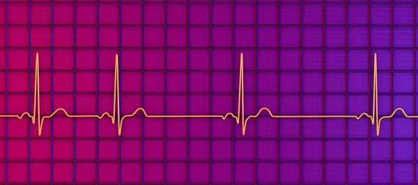 Illustration Détaillée Électrocardiogramme Ecg Présentant Une Arythmie Sinusale Une Condition — Photo