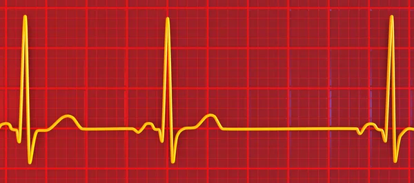 รายละเอ ยดภาพ ของ Electrocardiogram Ecg แสดงภาวะห วใจเต งหวะท ดจากปมไซน — ภาพถ่ายสต็อก