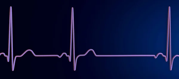 副不整脈を示す心電図の詳細な3Dイラスト 副鼻腔から発信される不規則な心臓のリズムが特徴的な状態 — ストック写真
