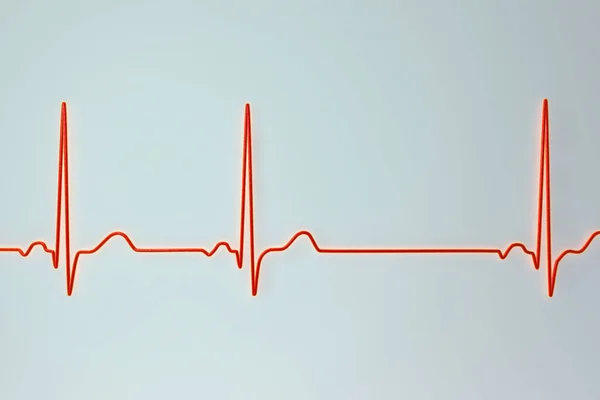 Részletes Illusztráció Elektrokardiogram Ekg Mutató Sinus Arrhythmia Állapot Jellemzi Szabálytalan — Stock Fotó