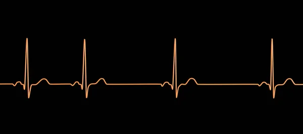 Eine Detaillierte Illustration Eines Elektrokardiogramm Ekgs Zur Darstellung Von Sinusrhythmusstörungen — Stockfoto