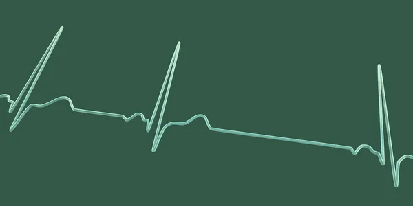 心电图显示窦性心律失常的详细三维图像 窦性心律失常是以窦性心律失常为特征的心律失常 — 图库照片