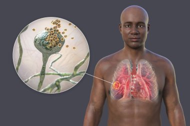 Şeffaf derisi olan bir Afrikalı 'nın üst kısmının 3 boyutlu fotorealistik bir çizimi akciğer mukozis lezyonunu ortaya çıkarıyor ve Rhizopus mantarlarına yakından bakıyor.